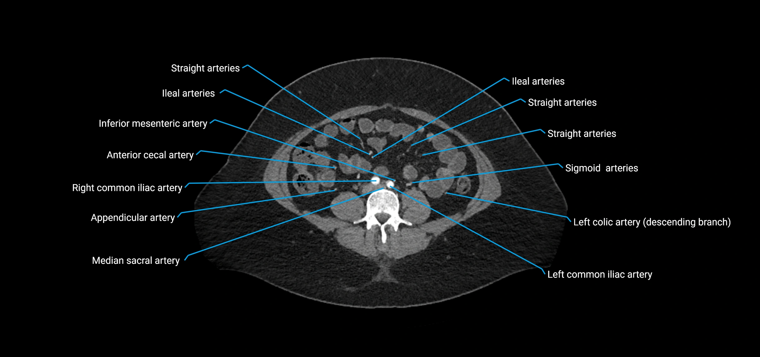 CTA abdomen axial cross sectional anatomy labelled image_138 (2).webp